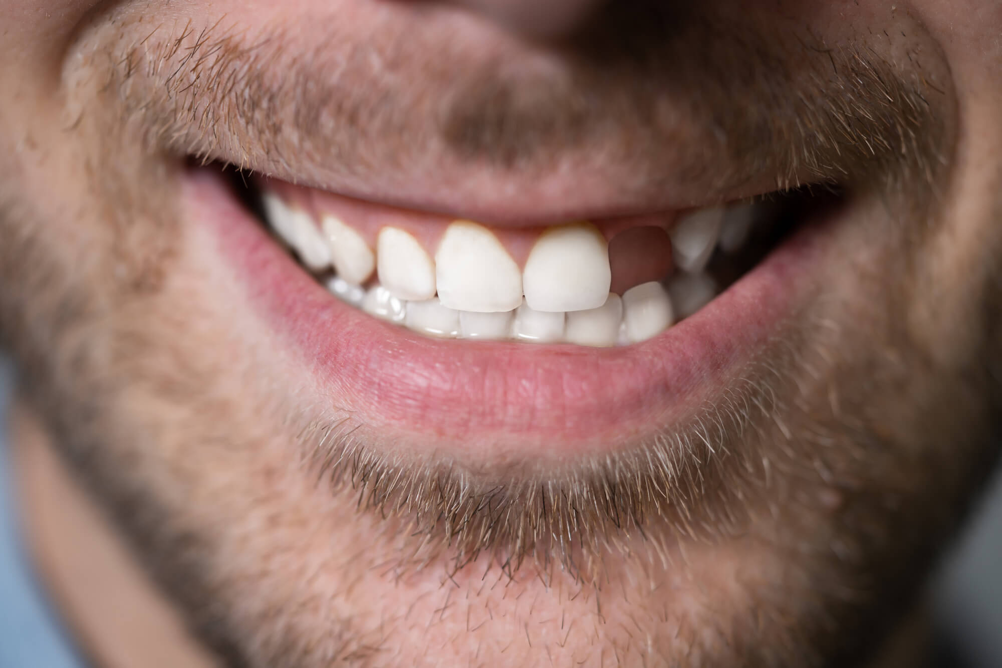 man with missing teeth needing a Fort Pierce Family Dentist